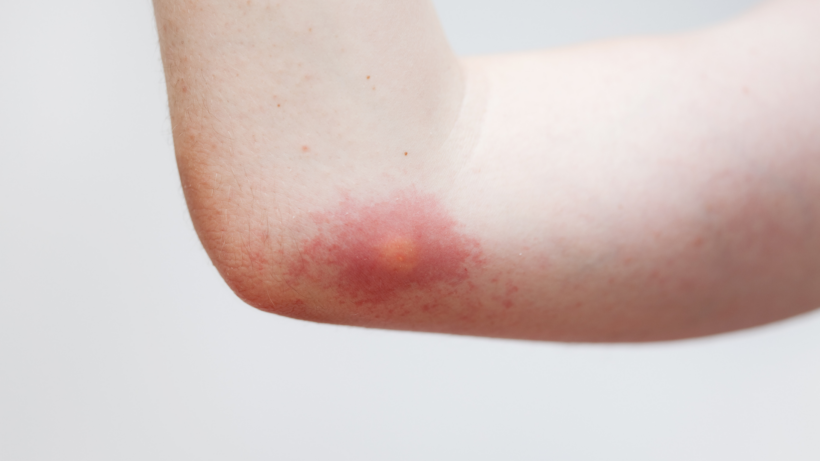 Comment soulager une piqûre de guêpe rapidement ?