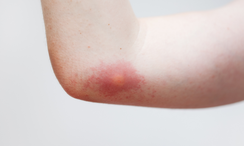 Comment soulager une piqûre de guêpe rapidement ?